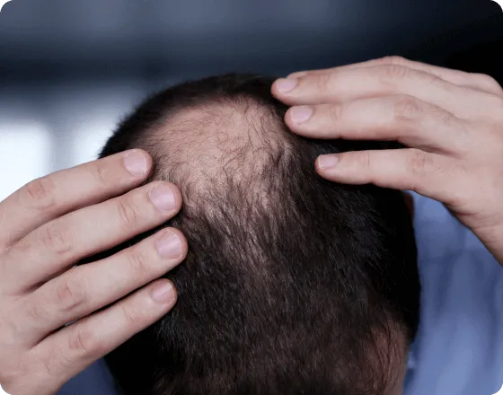 Calvitie et perte de cheveux